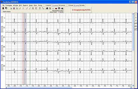 Cardio-Diabetological Module. ECG registration.