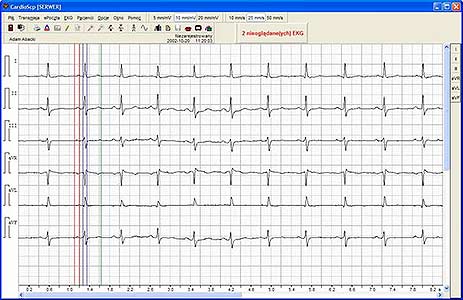 Moduł Kardiologiczno-Diabetologiczny. Zapis przebieg EKG.